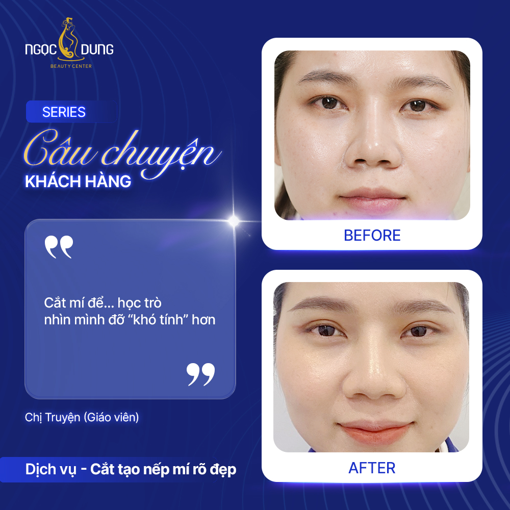 Chị Truyện - Tự tin sau khi cắt tạo mí rõ đẹp 3 CHI TRUYEN