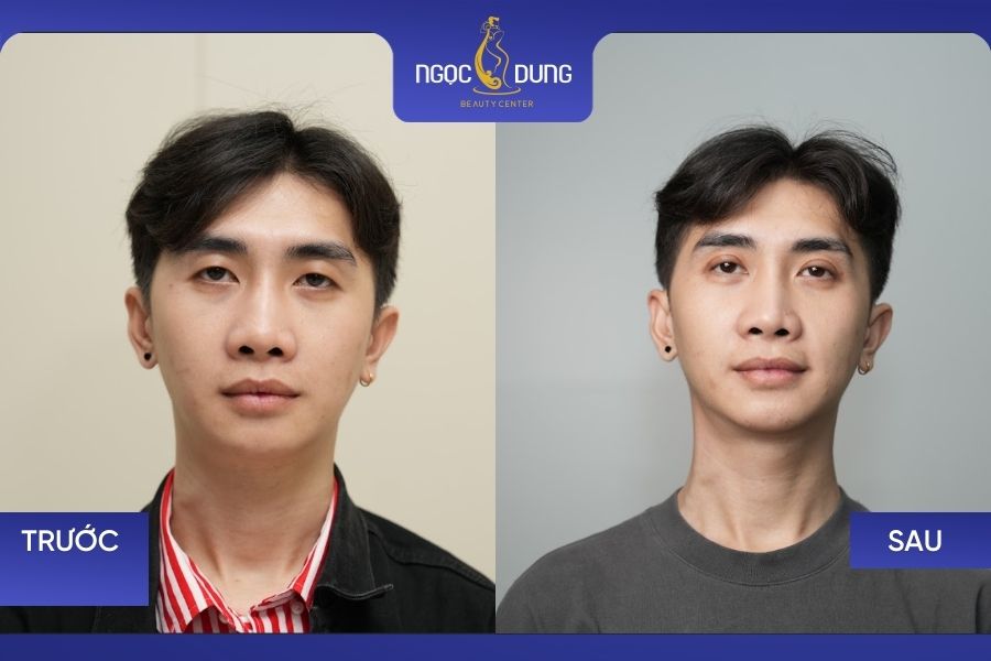 khách hàng thực hiện cắt mí trên tại Ngọc Dung