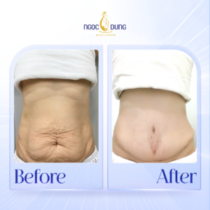 cai thien vung da bung bi trung xe