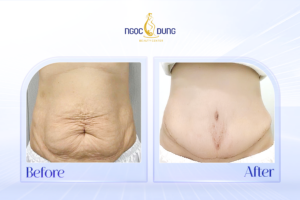 cang da bung bi trung