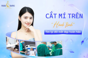 Cắt mí trên