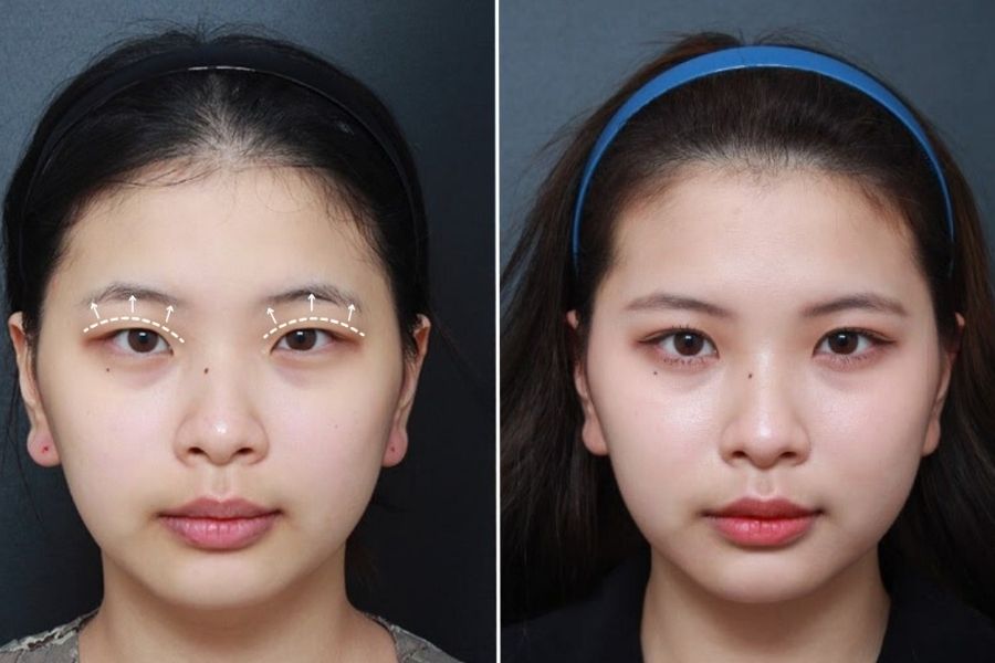 Chăm sóc mí mắt sau phẫu thuật cắt mí trên