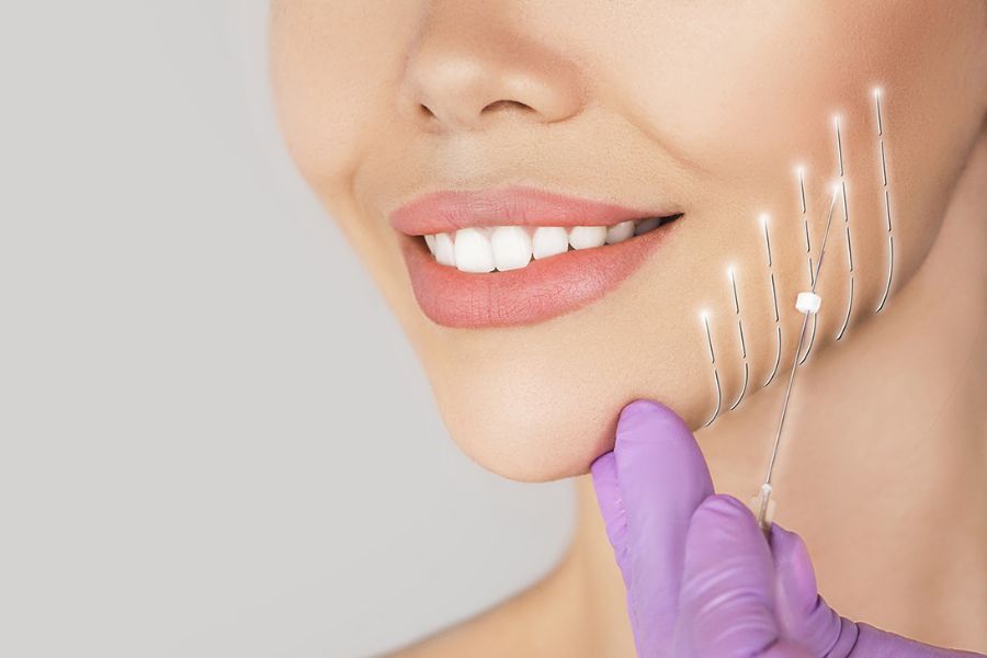 Căng da mini má xệ giúp gương mặt hài hòa và trẻ trung hơn