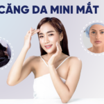 Căng da mini má xệ