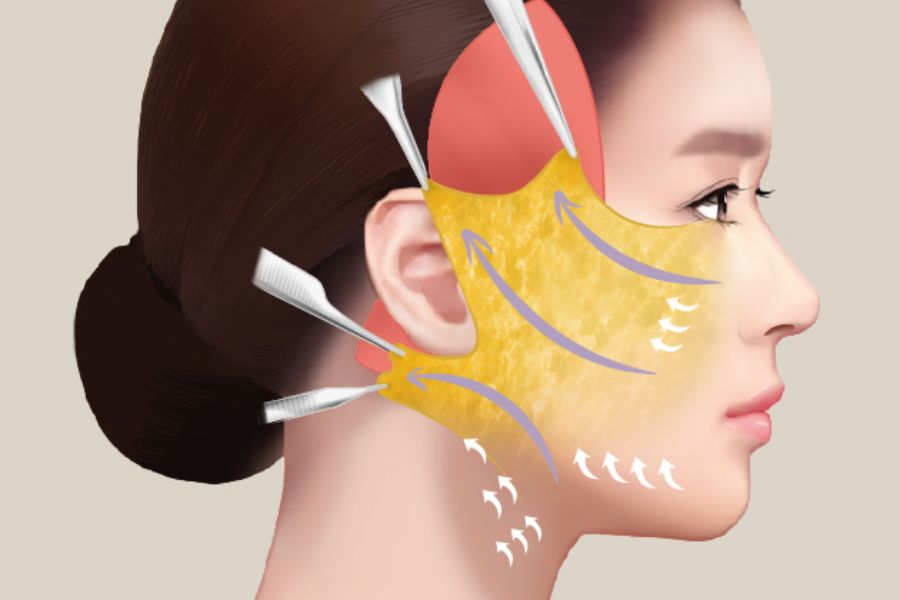 Căng da nọng còn có lợi cho sức khỏe da về lâu về dài