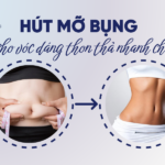 Hút mỡ bụng