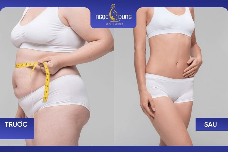 Nhiều khách hàng đã có màn lột xác ngoạn mục sau khi hút mỡ bụng tại bệnh viện thẩm mỹ Ngọc Dung