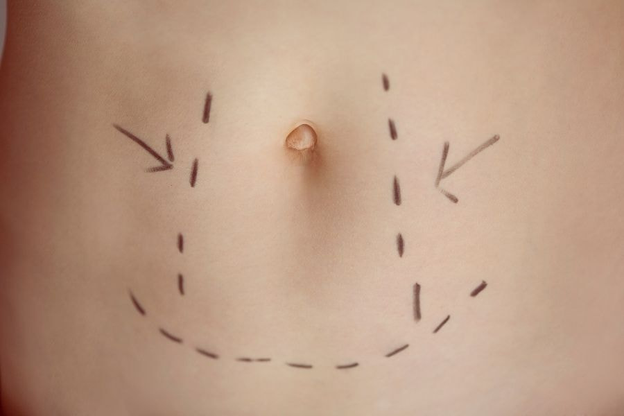 Hút mỡ bụng mang lại hiệu quả nhanh và rõ rệt hơn phương pháp truyền thống