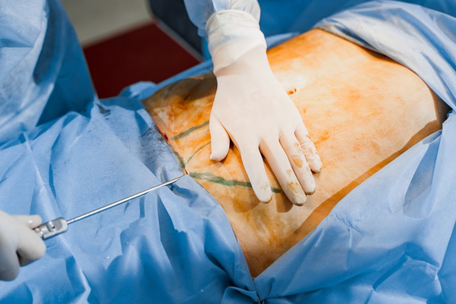 Hãy hút mỡ eo tại các bệnh viện thẩm mỹ uy tín