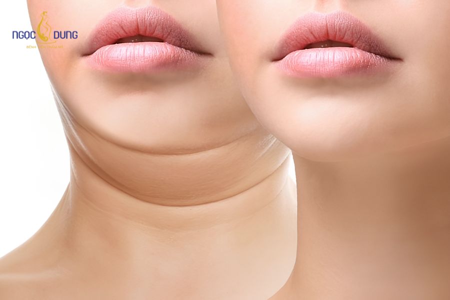 Căng da nọng cằm là gì? Phương pháp và quy trình 2026 10 Kỹ thuật can thiệp mô mềm giúp xóa nọng cằm, định hình viền hàm