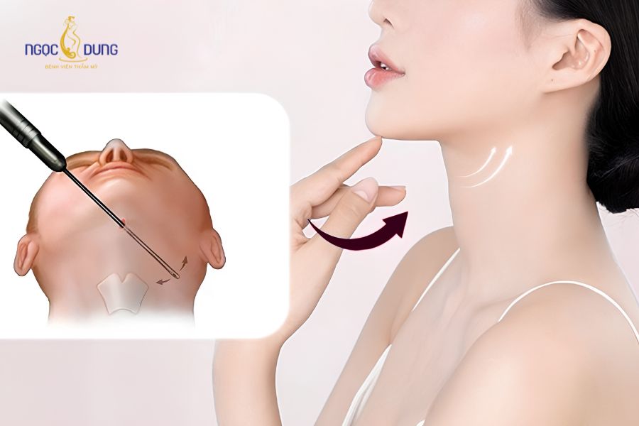 Căng da nọng cằm là gì? Phương pháp và quy trình 2026 16 Quy trình trẻ hóa vùng cằm cổ khép kín chuẩn y khoa
