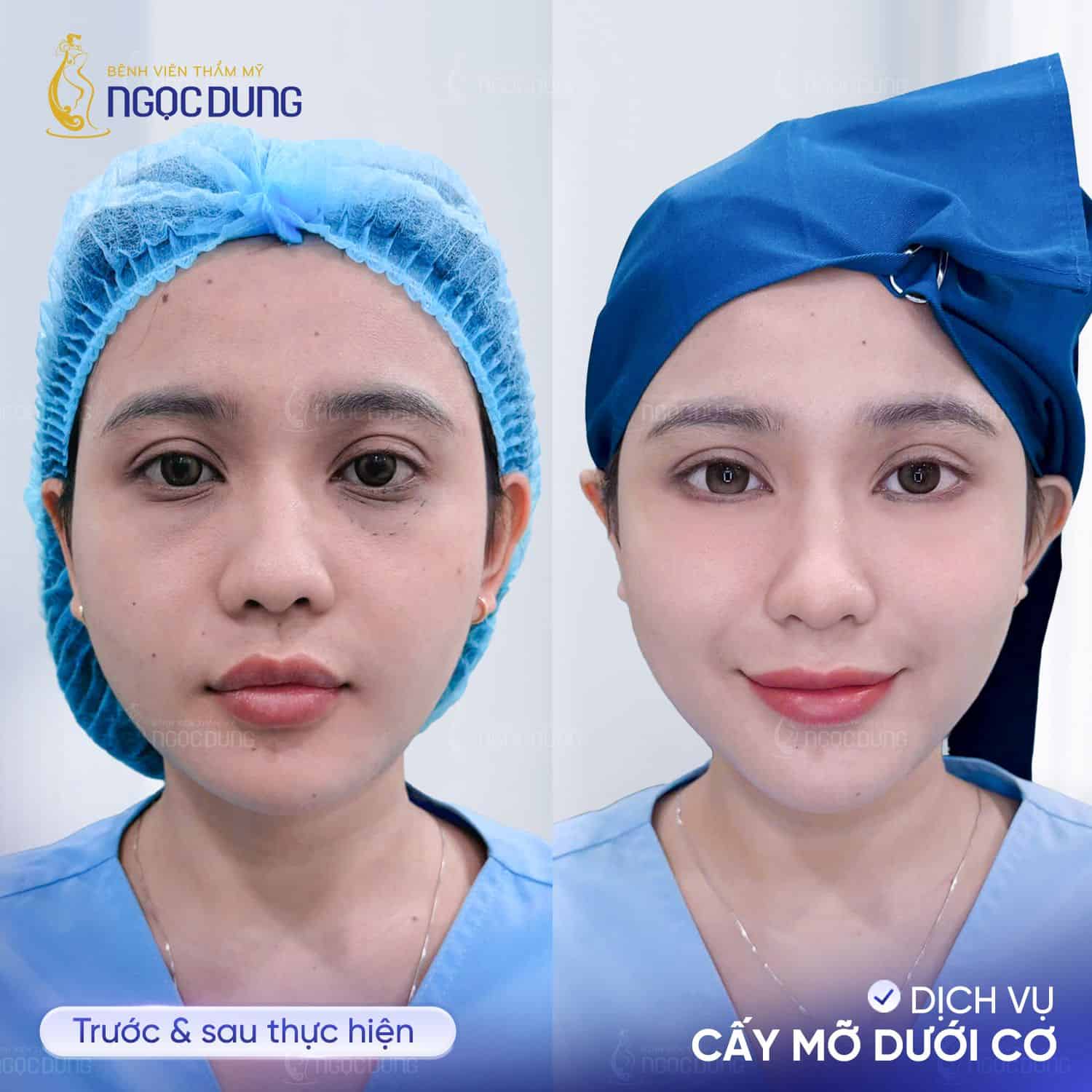 cấy mỡ dưới cơ 2