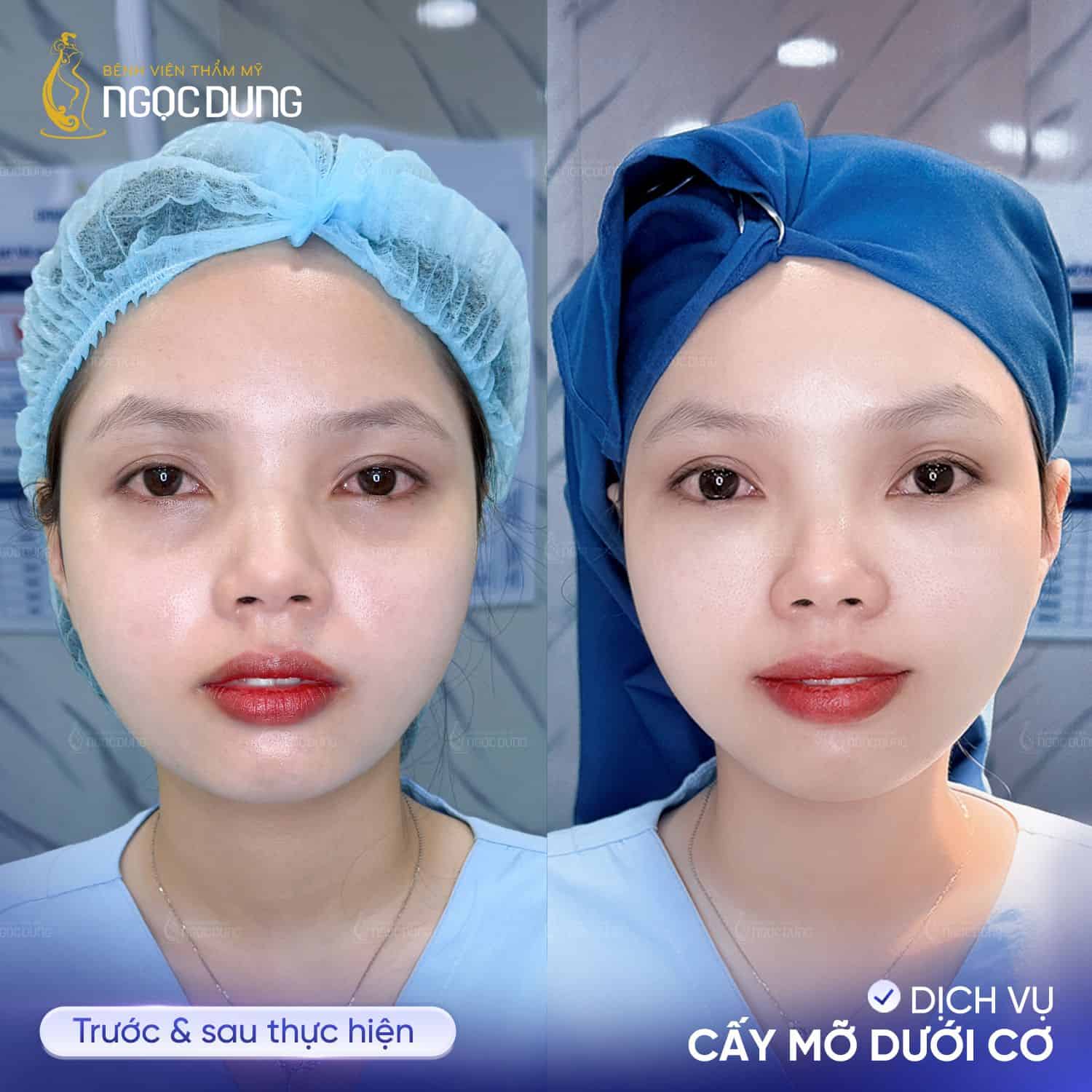 cấy mỡ dưới cơ