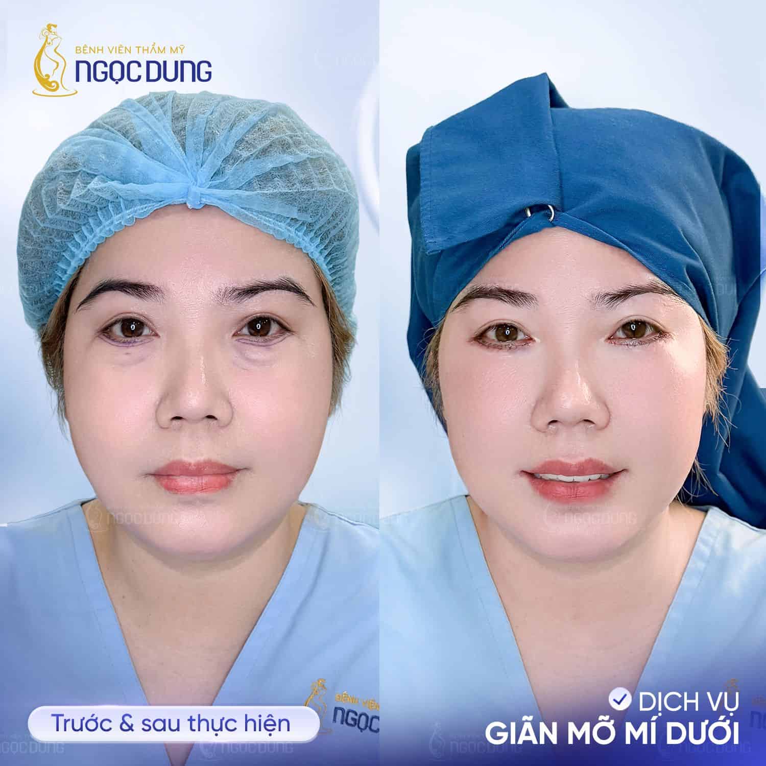 cấy mỡ mí dưới 2