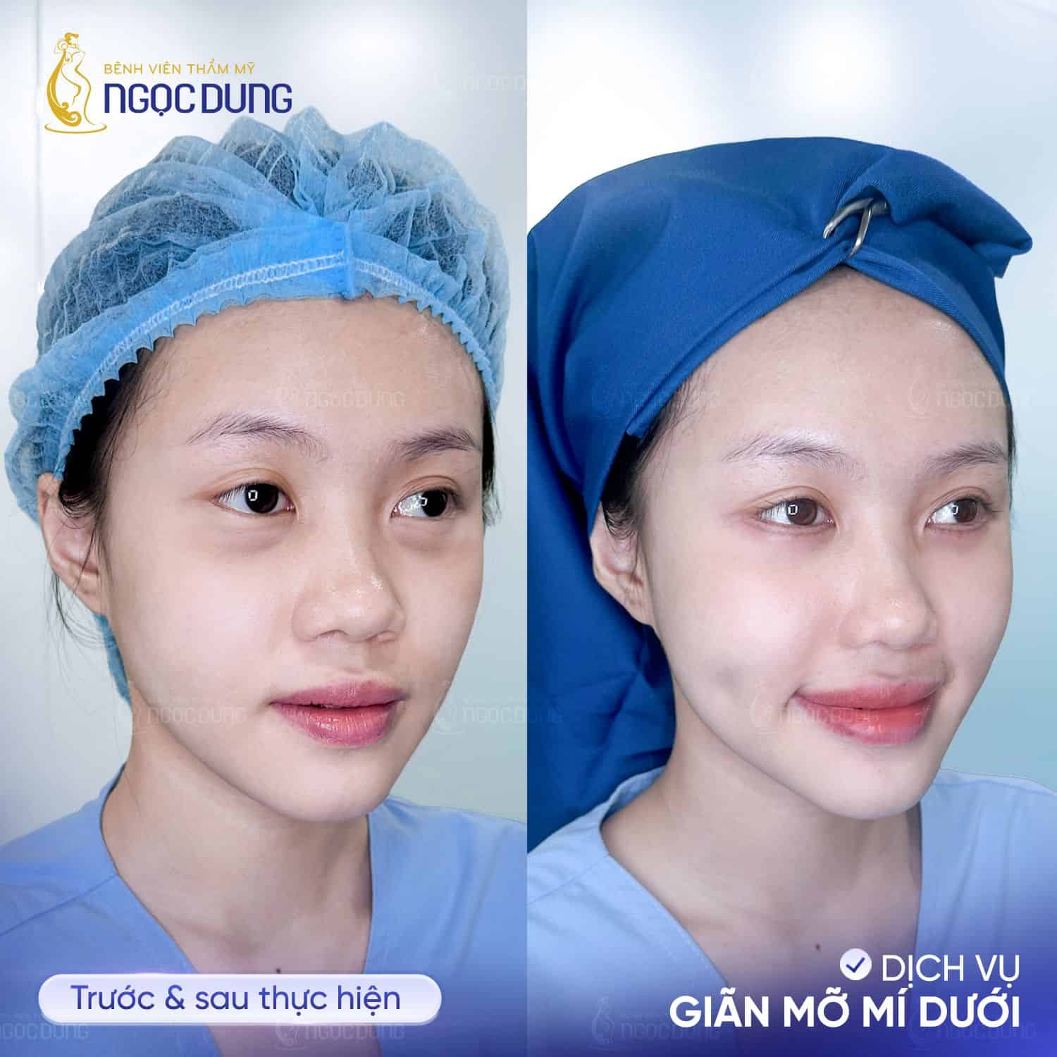 cấy mỡ mí dưới