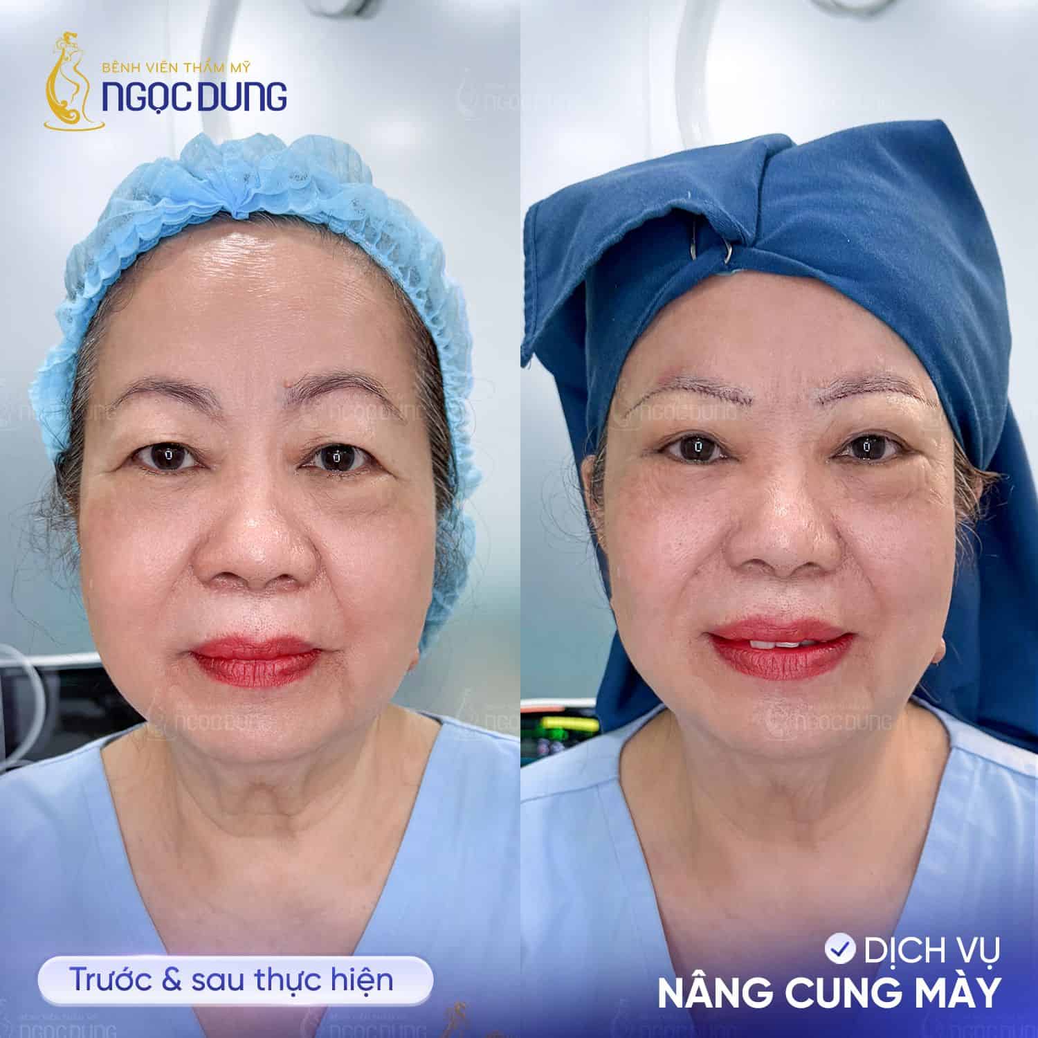 nâng cung chân mày