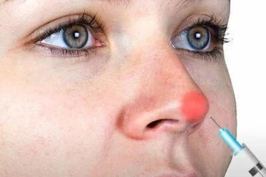 Tiêm chất làm đầy nâng mũi hiệu quả bao lâu? Giải đáp từ A-Z 26 Bạn có thể có cảm giác đau sau khi tiêm chất làm đầy nâng mũi