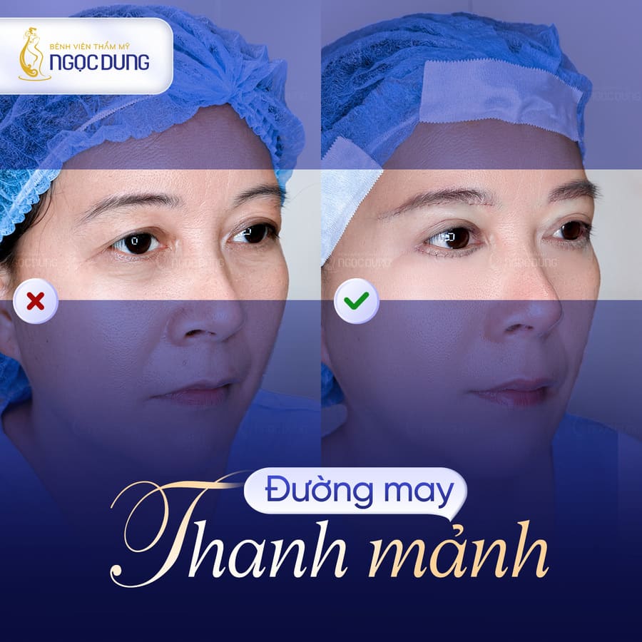 Cắt mí kiêng ăn gì? Thực phẩm không nên ăn sau khi cắt mí 18 Bệnh viện Thẩm mỹ Ngọc Dung ứng dụng kỹ thuật khâu với chỉ thanh mảnh, hỗ trợ nếp mí nhanh ổn định và hạn chế tối đa tình trạng bầm nề