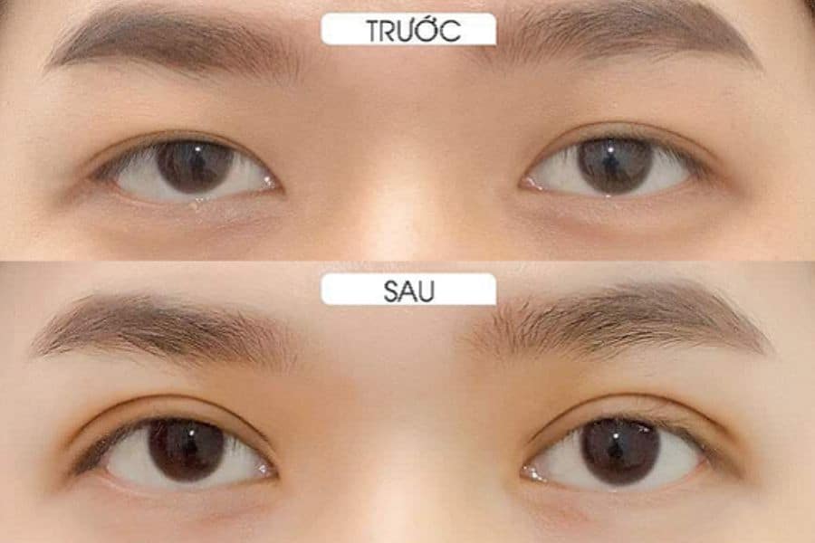 Tầm quan trọng và cách chăm sóc mí mắt sau khi cắt chỉ 18 Cần nắm rõ cách chăm sóc mí mắt sau khi cắt chỉ để có đôi mắt đẹp