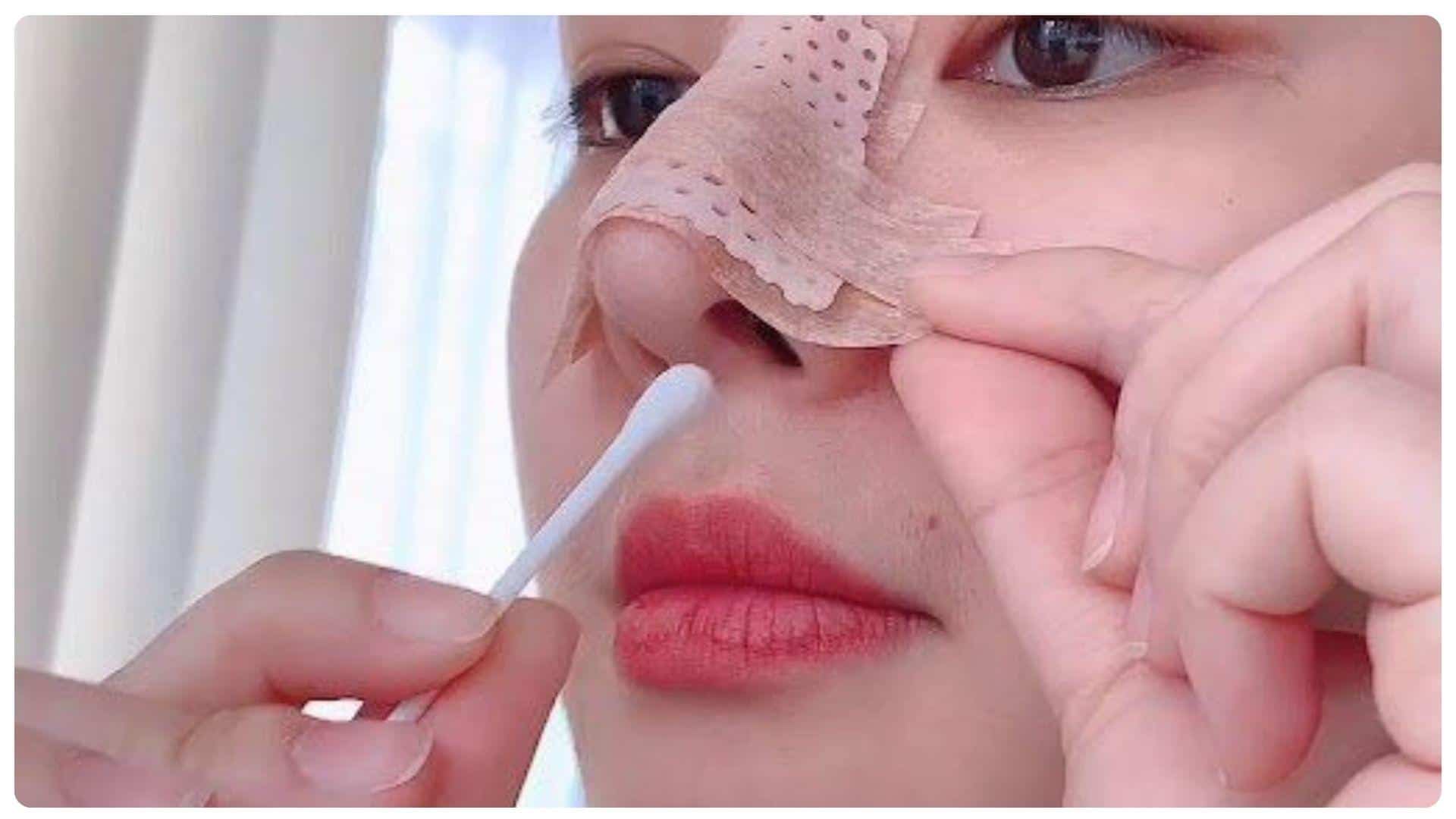 Dấu hiệu mũi không hợp sụn và cách phòng ngừa 22 Chăm sóc hậu phẫu đúng cách giúp mũi hồi phục ổn định hơn