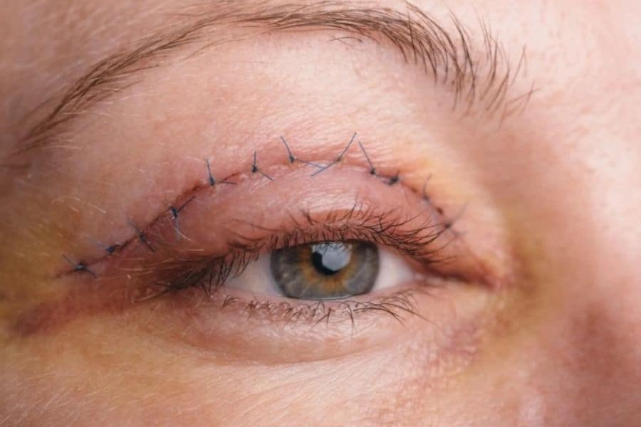 Tầm quan trọng và cách chăm sóc mí mắt sau khi cắt chỉ 14 Chăm sóc mắt cẩn thận sau khi cắt mí để vào form đẹp