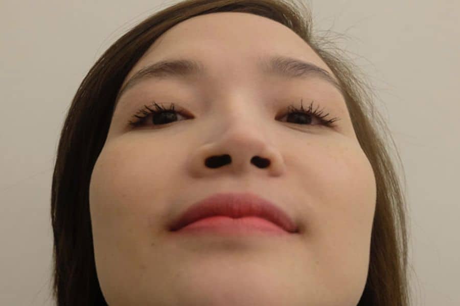 Nâng mũi cấu trúc được bao lâu? Các yếu tố ảnh hưởng 13 Chăm sóc sai cách có thể gây lệch mũi, viêm nhiễm