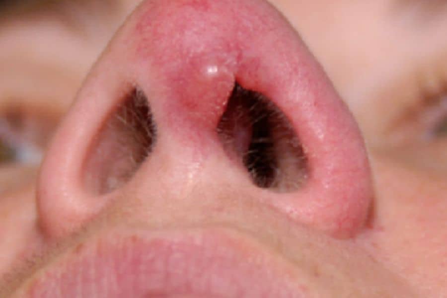 Nâng mũi cấu trúc được bao lâu? Các yếu tố ảnh hưởng 11 Cơ địa ảnh hưởng tới kết quả nâng mũi