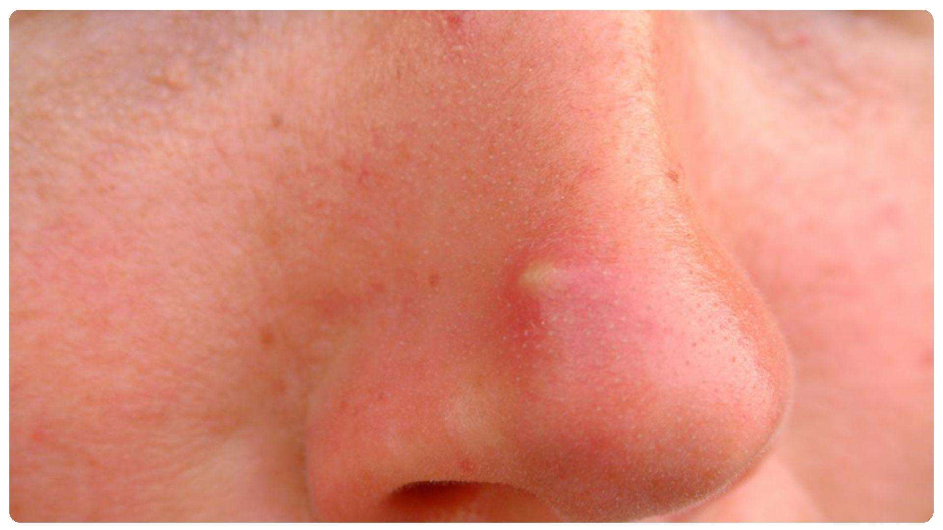 Dấu hiệu mũi không hợp sụn và cách phòng ngừa 16 Đau nhức kéo dài có thể liên quan đến dấu hiệu nâng mũi không hợp sụn