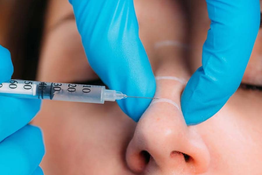 Tiêm chất làm đầy nâng mũi hiệu quả bao lâu? Giải đáp từ A-Z 20 Động mạch mũi có nhánh thông với võng mạc nên có thể gây mù lòa nếu tiêm sai cách