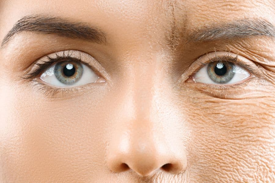 Căng chỉ Vline là gì? Hiệu quả, quy trình thực hiện 11 Giảm thiểu nếp nhăn và lão hóa chảy xệ trên da