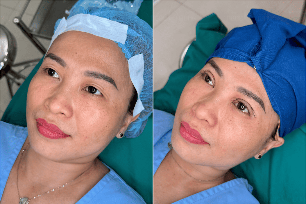 Cắt mí mắt bao lâu thì lành? Cách chăm sóc sau cắt mí 18 Hình ảnh khách hàng cắt mí mắt tại BVTM Ngọc Dung