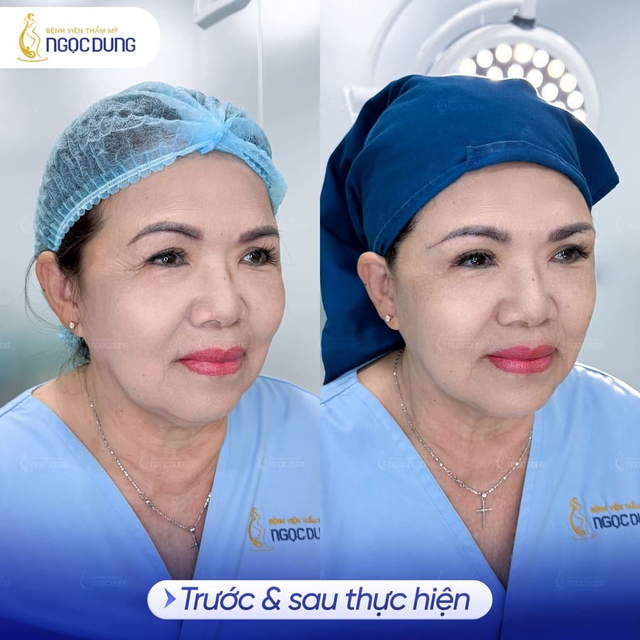 Nâng cung chân mày có để lại sẹo không? Bao lâu thì hết sẹo 14 Kết quả thực tế trước và sau khi nâng cung chân mày tại Bệnh viện Thẩm mỹ Ngọc Dung