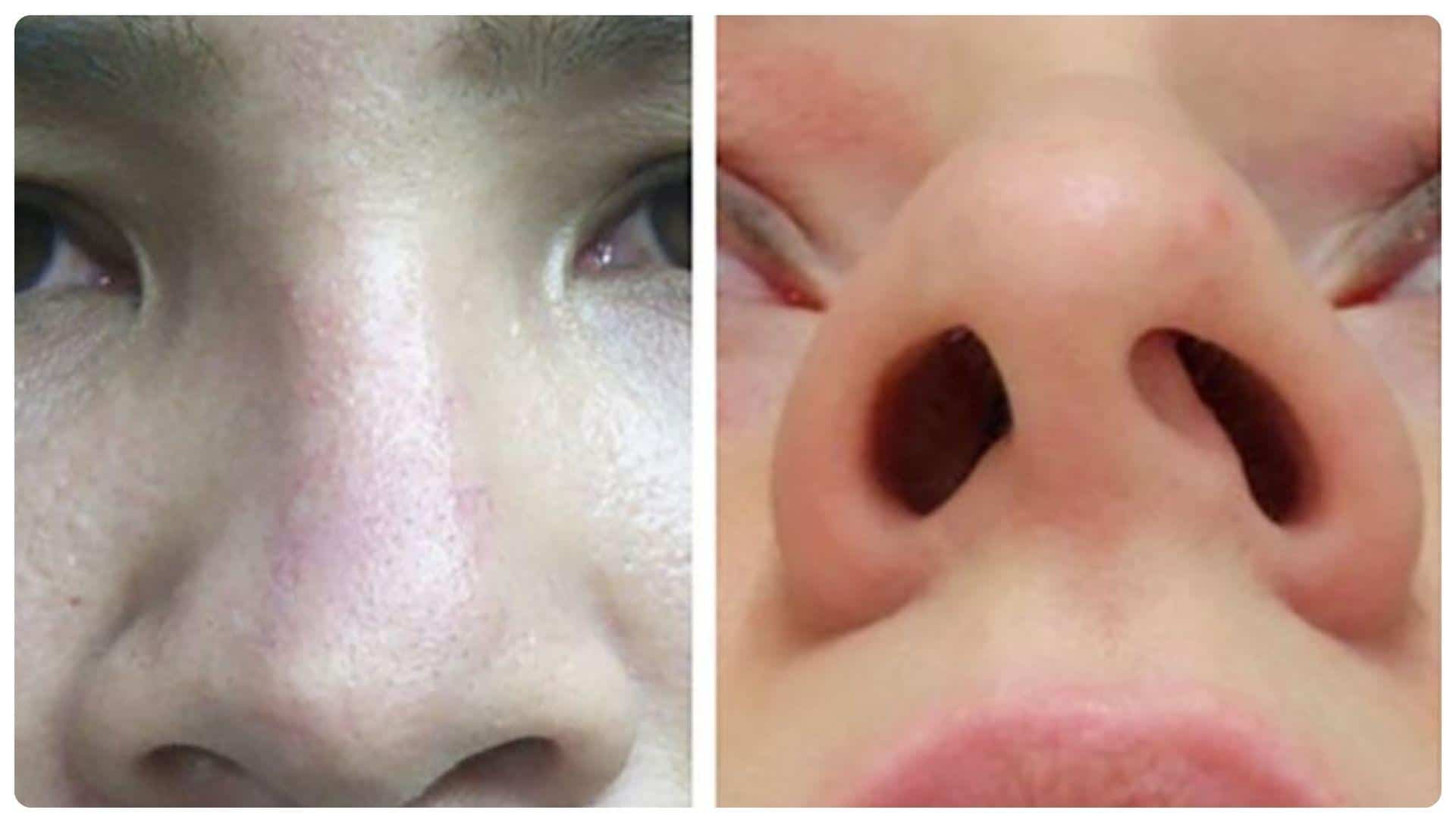 Dấu hiệu mũi không hợp sụn và cách phòng ngừa 20 Khi xuất hiện dấu hiệu mũi không hợp sụn, cần xử lý sớm để tránh biến chứng