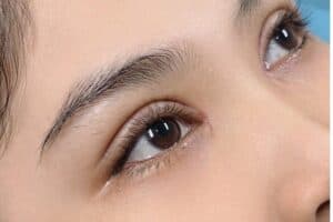 Khoảng 3-6 tháng mí mắt sẽ ổn định