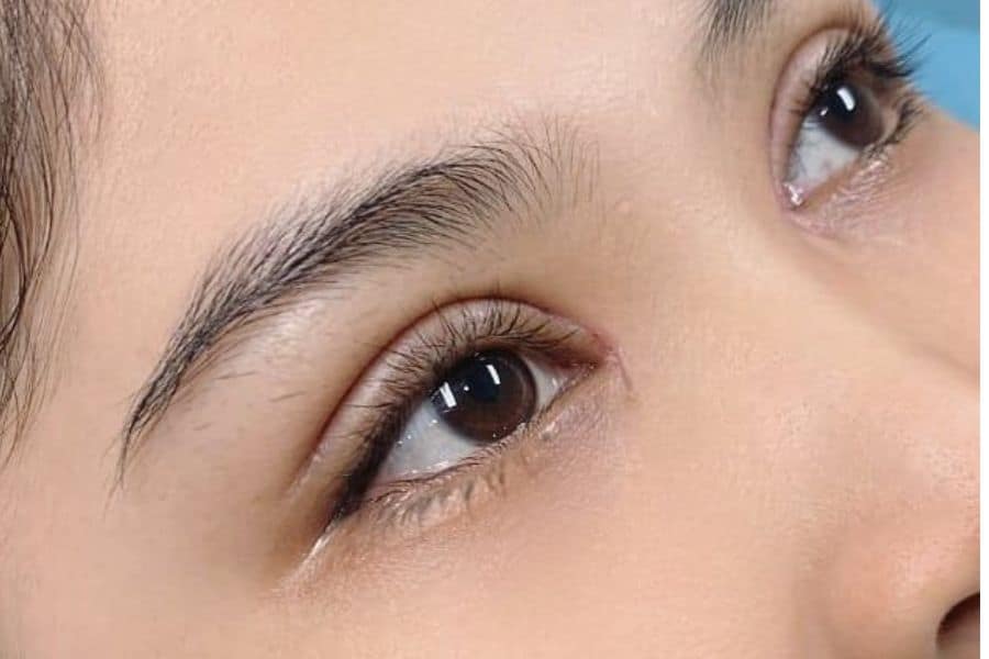 Cắt mí mắt bao lâu thì lành? Cách chăm sóc sau cắt mí 11 Khoảng 3-6 tháng mí mắt sẽ ổn định