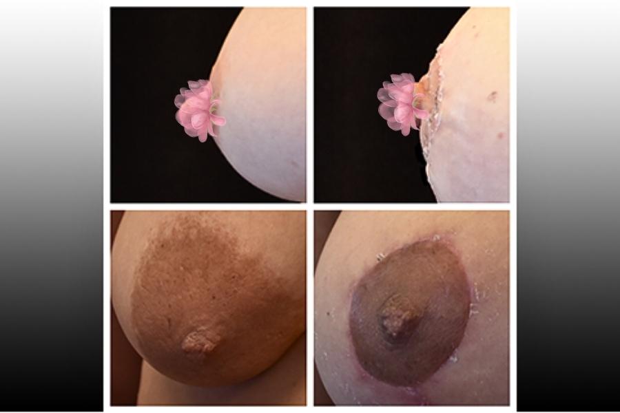 Thu nhỏ quầng nhũ hoa giá bao nhiêu? Bảng giá mới nhất 2026 16 Không nên thực hiện thu gọn quầng nhũ hoa giá rẻ