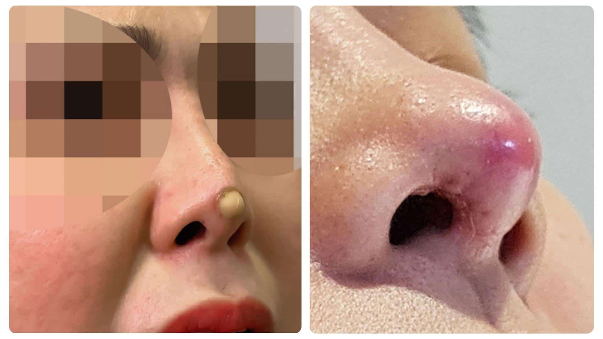 Dấu hiệu mũi không hợp sụn và cách phòng ngừa 17 Lộ sụn ở đầu mũi là tình trạng cần được xử lý sớm