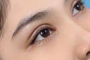 cách giảm sưng mắt sau khi cắt mí