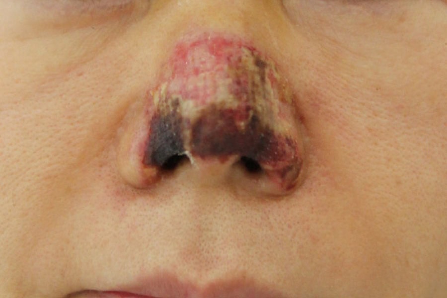 Tiêm chất làm đầy nâng mũi hiệu quả bao lâu? Giải đáp từ A-Z 22 Mũi bị hoại tử do tiêm chất làm đầy kém chất lượng tại cơ sở thẩm mỹ thiếu uy tín