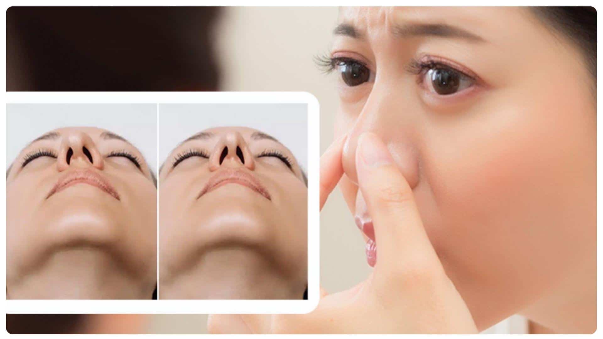 Dấu hiệu mũi không hợp sụn và cách phòng ngừa 15 Mũi bị lệch hoặc vẹo có thể liên quan đến tình trạng lệch sụn mũi