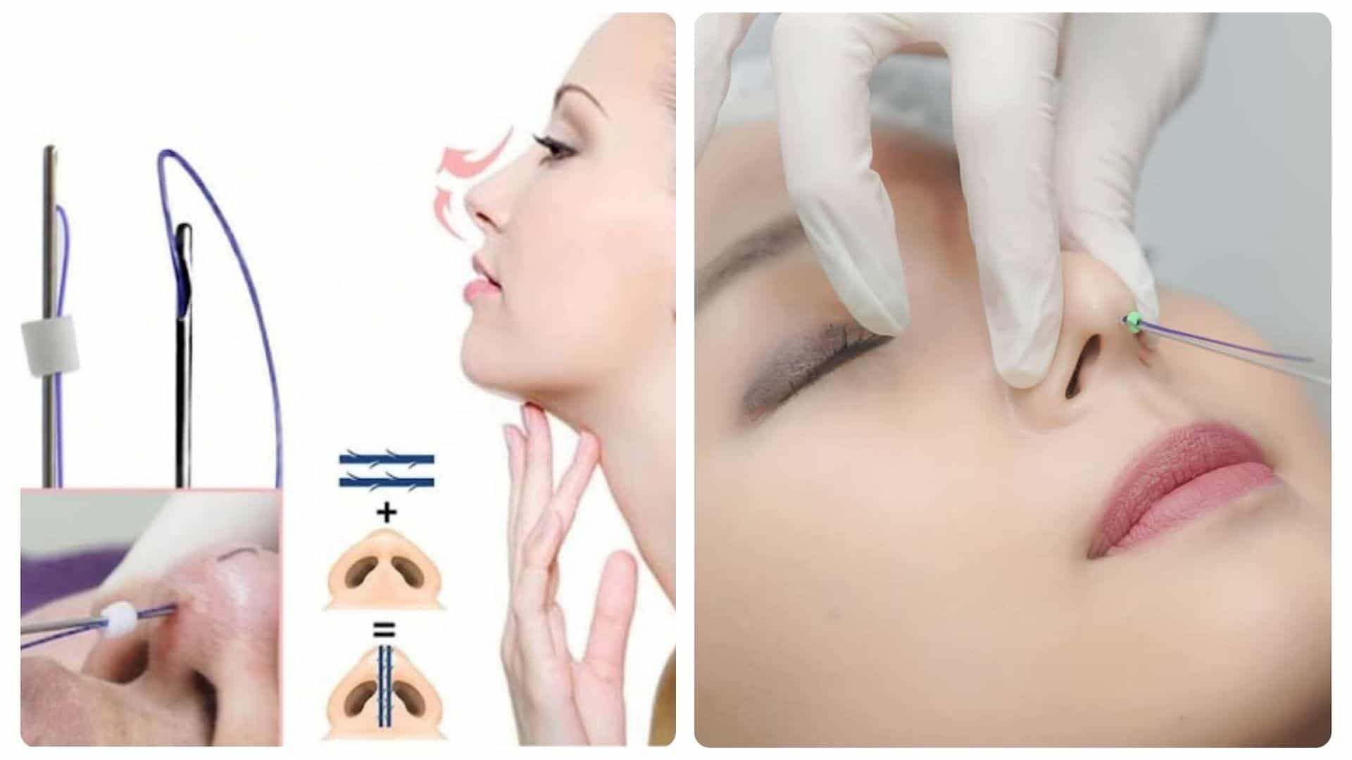 Nâng mũi chỉ giữ được bao lâu? Cách chăm sóc dáng mũi bền lâu 14 Mũi cao, mềm mại, tự nhiên nhờ kỹ thuật đặt chỉ chuẩn xác