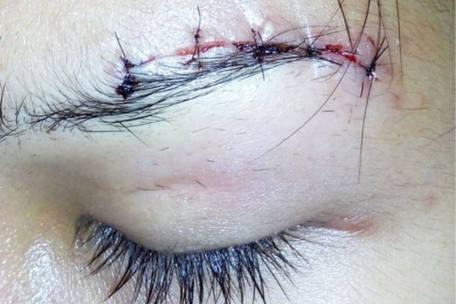 Nâng cung chân mày có để lại sẹo không? Lưu ý để tránh sẹo 11 nang cung chan may co de lai seo khong 2