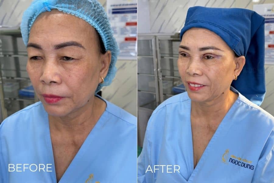 Nâng cung chân mày có để lại sẹo không? Lưu ý để tránh sẹo 15 nang cung chan may co de lai seo khong 4