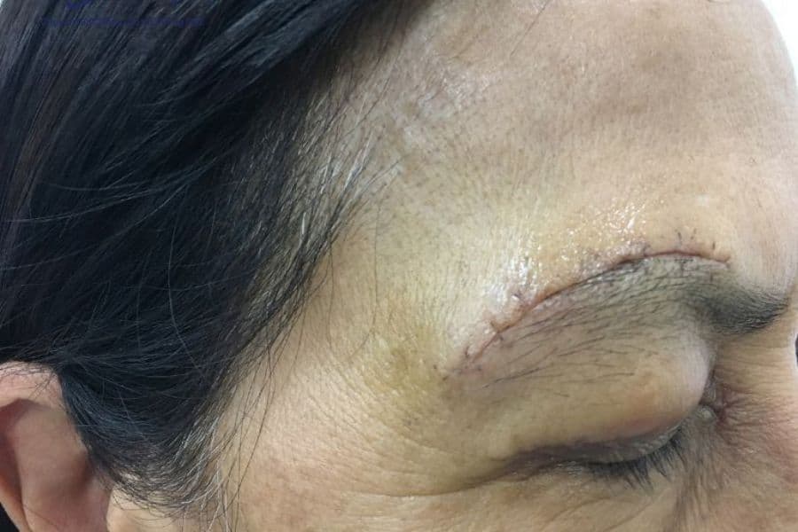 Nâng cung chân mày có để lại sẹo không? Lưu ý để tránh sẹo 10 Nâng cung chân mày để lại sẹo không