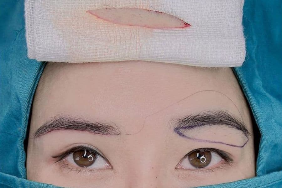 Nâng cung chân mày có để lại sẹo không? Lưu ý để tránh sẹo 13 nang cung chan may co de lai seo khong 8