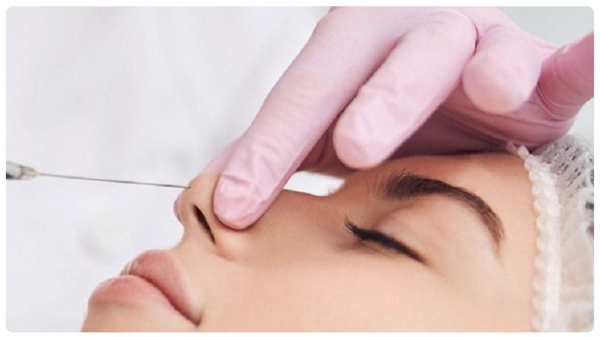 Nâng mũi chỉ giữ được bao lâu? Cách chăm sóc dáng mũi bền lâu 19 Nâng mũi bằng chỉ có thể kéo dài từ 12–24 tháng