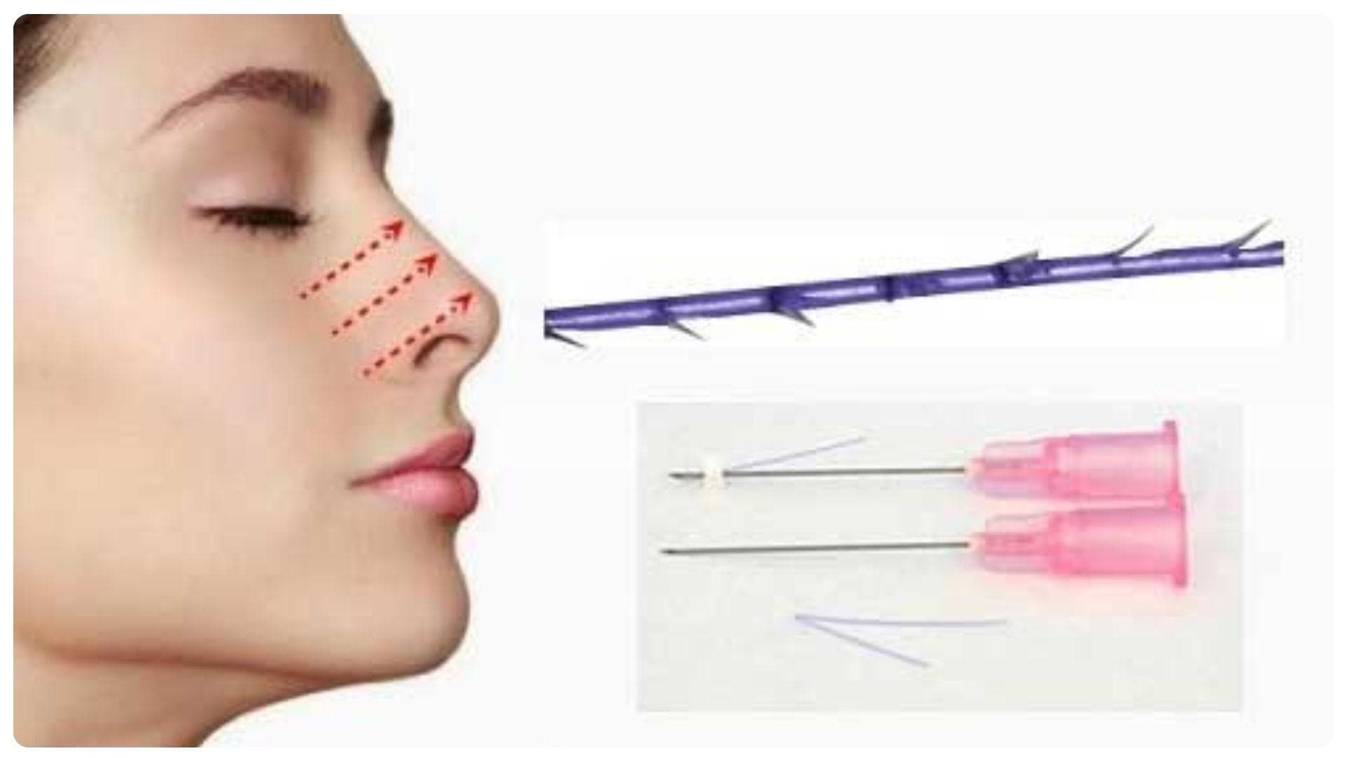 Nâng mũi chỉ giữ được bao lâu? Cách chăm sóc dáng mũi bền lâu 12 Nâng mũi bằng chỉ là phương pháp thẩm mỹ không phẫu thuật