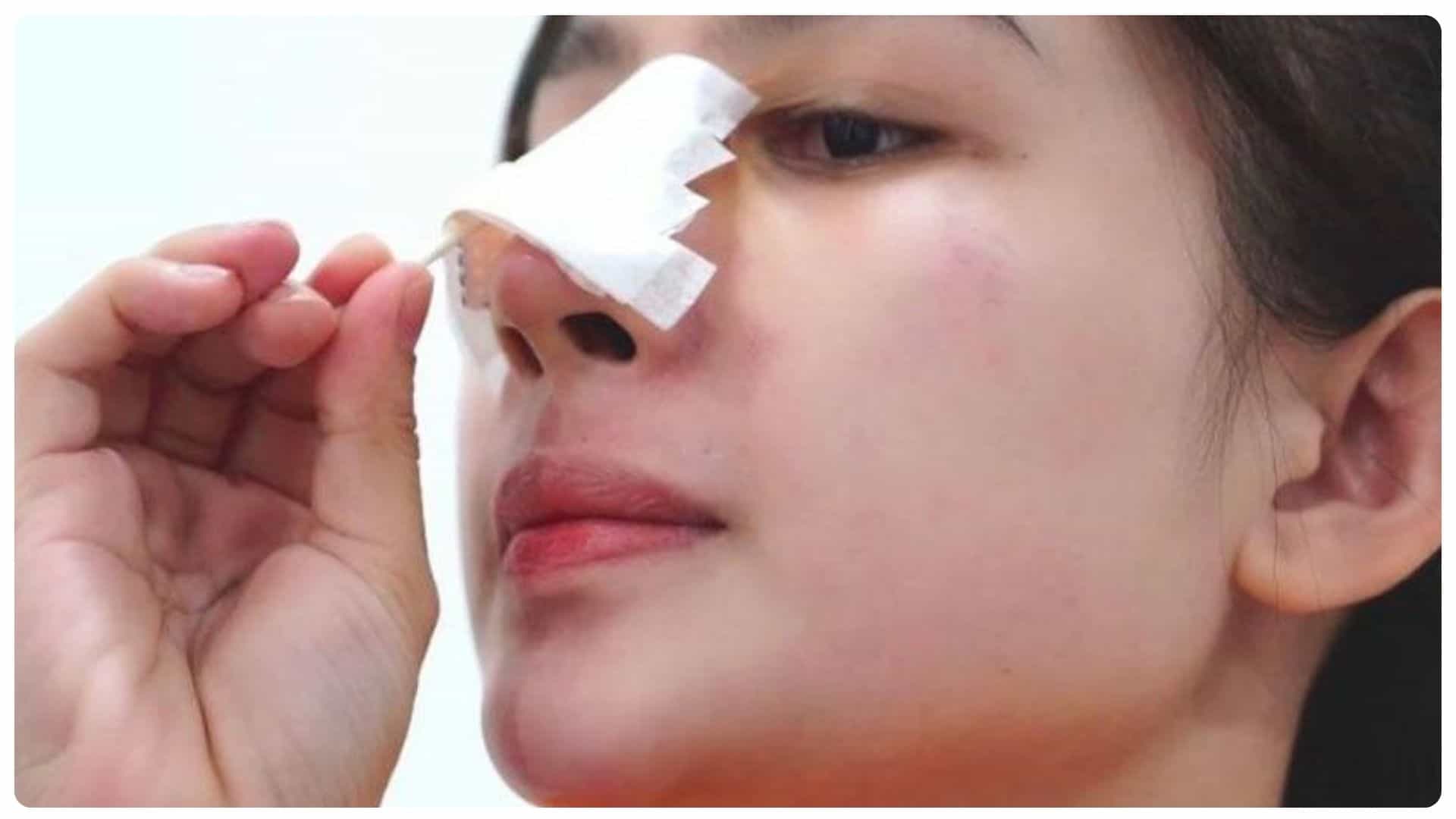 Nâng mũi bao lâu thì đầu mũi hết to? Những yếu tố ảnh hưởng 17 nang mui bao lau thi dau mui het to 10