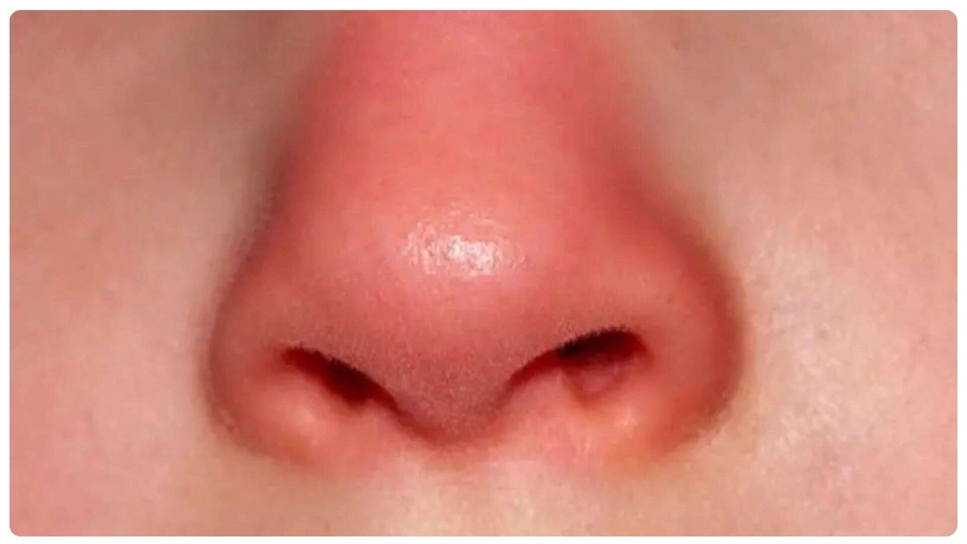 Nâng mũi bao lâu thì đầu mũi hết to? Những yếu tố ảnh hưởng 11 Nâng mũi bao lâu thì đầu mũi hết to?