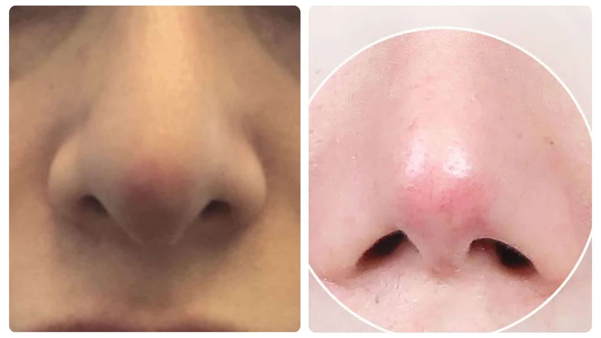 Nâng mũi bao lâu thì đầu mũi hết to? Những yếu tố ảnh hưởng 14 nang mui bao lau thi dau mui het to 12